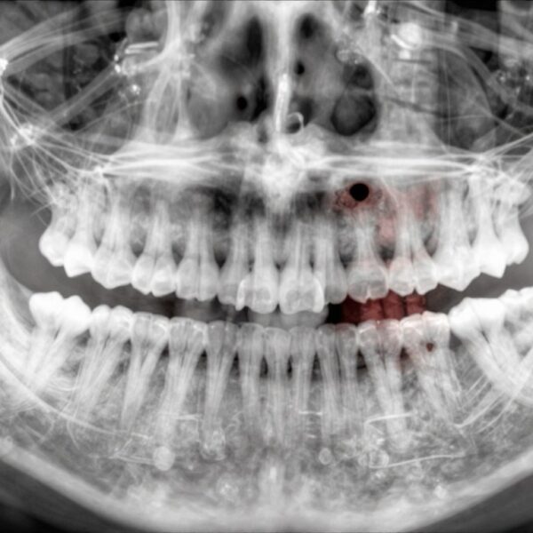 RTG szczęki – kiedy dentysta zleca zdjęcie i co można na nim zobaczyć?