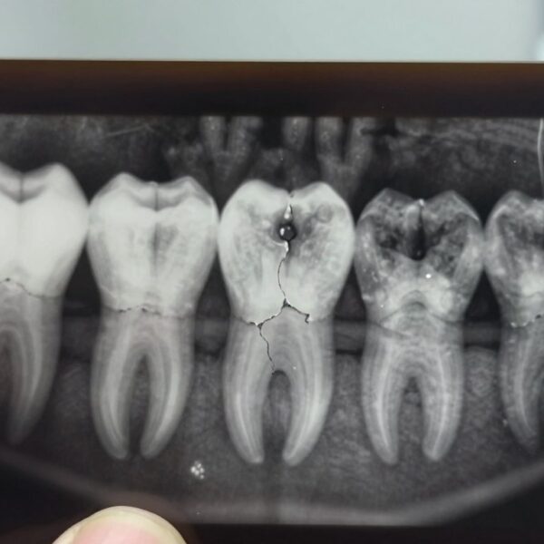 RTG zęba jak odczytać i które zmiany warto skonsultować z dentystą?