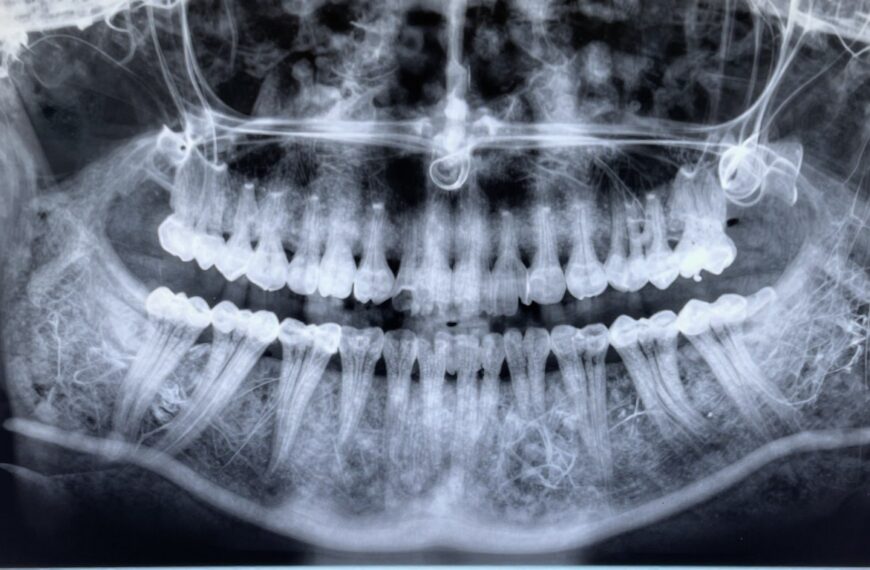 Ząb do leczenia kanałowego RTG – co pokazuje zdjęcie przed endodoncją?
