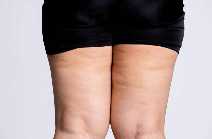 Jak przygotować się do specjalistycznej konsultacji przy podejrzeniu lipodemii?